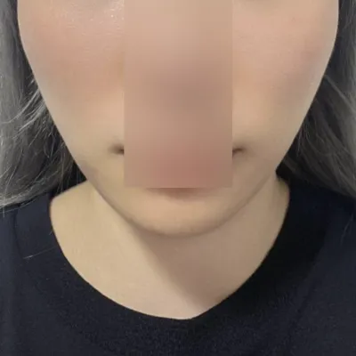 Намайг зовоож байсан хамар уруулын атирааг шийдвэрлэсэн шүү ~