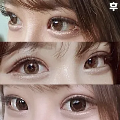 Нүдний мэс засал хийлгэснээс хойш 3 долоо хоног болж байна.хаха