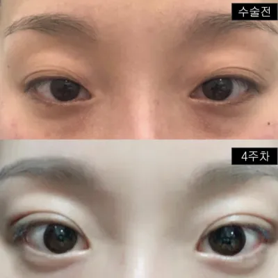 Унжсан зовхи, давхар зураасны асуудлыг шийдлээ