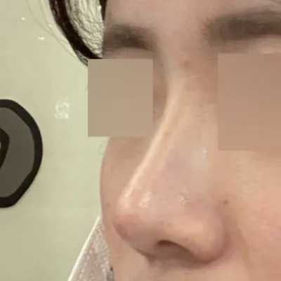 Хамрын мэс засал хийлгэснээс хойш хоёр сар боллоо!