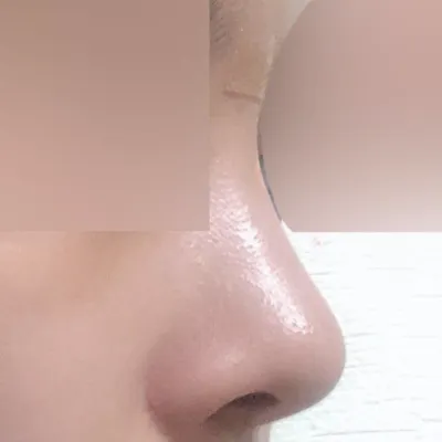 Хамрын мэс заслын дараах 3 сарын тойм