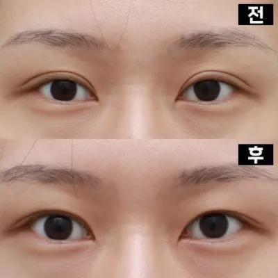 Хиамны нүдний дахин хагалгаа, нүдний хэлбэр засалтыг хүртэл хийлгэлээ!