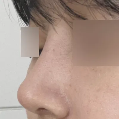 Хамрын мэс засал хийлгэсний дараах нэг сарын тойм: Амжилттай боллоо!