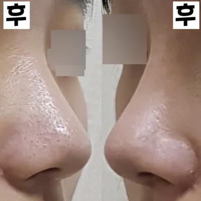 Хамрын анхны хагалгаанаас хойш 2 долоо хоног боллоо!