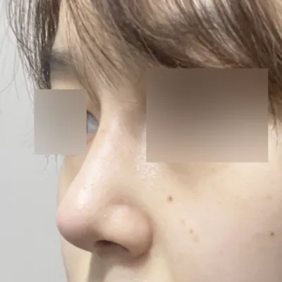 Вийвэрс гоо сайхны мэс заслын эмнэлэгт хамрын дахин мэс засал хийлгэсний дараах нэг сарын дараах сэтгэгдэл~! 