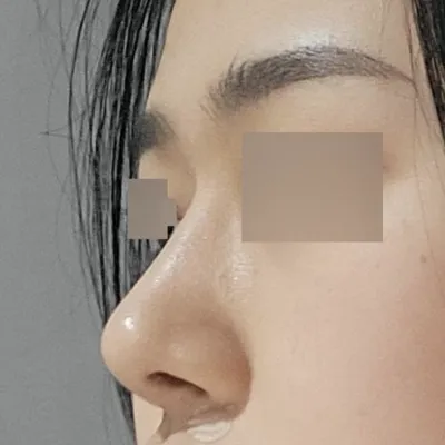 Би Виверсэд мэс засал хийлгэснээс хойш 5 сар болж байна