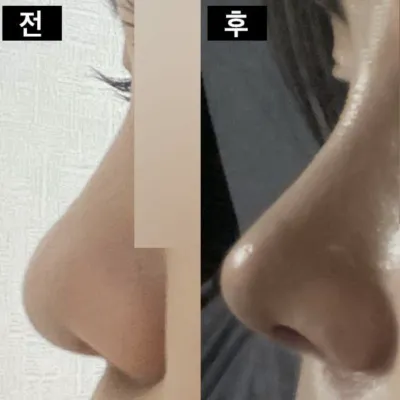 Хамрын мэс засал хийлгээд сар болж байна даа хэх