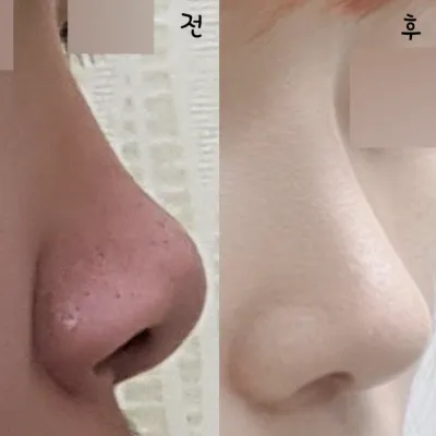 Мэс засал хийлгэсний дараа өөртөө итгэлтэй болсон!!