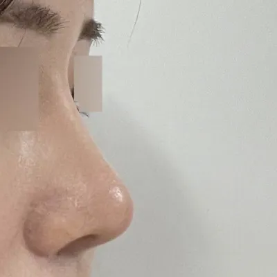 Хамрын мэс засал хийлгэснээс хойш 3 сар боллоо!