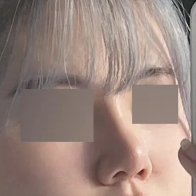 Засваргүйгээр гоё хамартай болсондоо баярлаж, эмчид маш их баярлалаа!