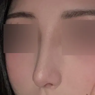 Би шувуун хамартаа стресстэж, шийдээд хагалгаанд орсон!!