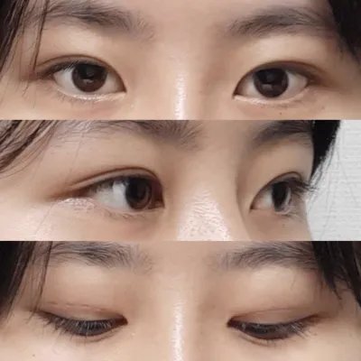 Нүдний хөх 2 долоо хоногийн дотор бүрэн арилж, сорви, шархгүй цэвэрхэн болсон!