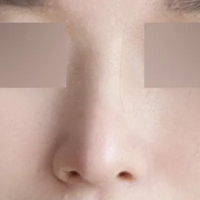 Хамрын мэс засал хийлгэснээс хойш 6 сар өнгөрчээ