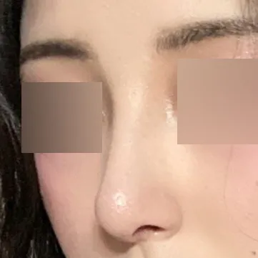 Мэс засал хийлгэснээс хойш нэг сар болж байна.