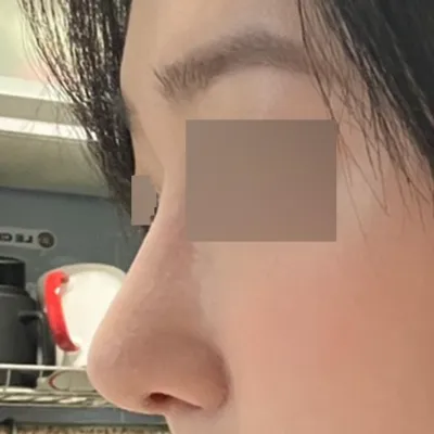 Анхны хамар заслын мэс засалд энд тэндгүй санаа зовж байгаад эцэст нь хамар засууллаа.