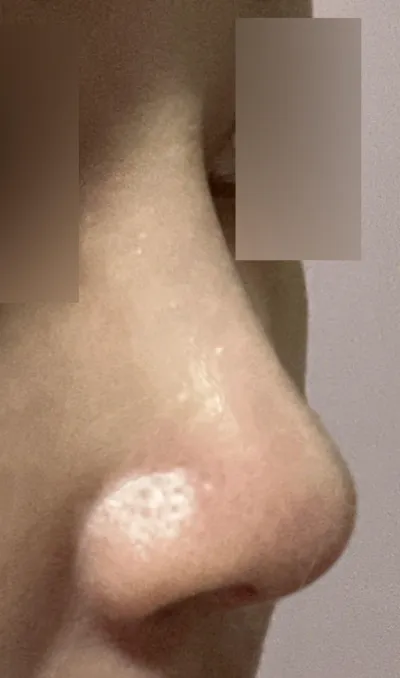 Мэс засал хийлгээд 6 сар болжээ