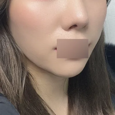 Гоо сайхны мэс заслын Peach Thread Lift хийлгэснээс хойш 3 сар боллоо