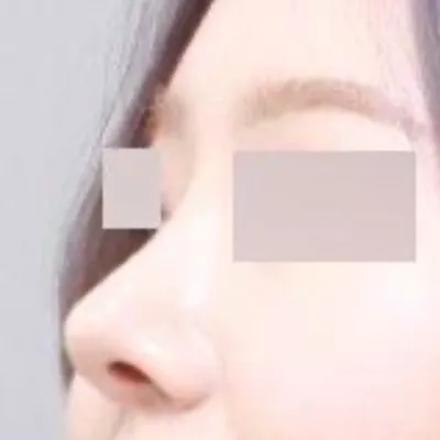 Хэлбээ алдагдсан бөгтөр хамар засварын мэс засал хийлгэснээс хойш 6 сар болж байна шүү дээ. хехе