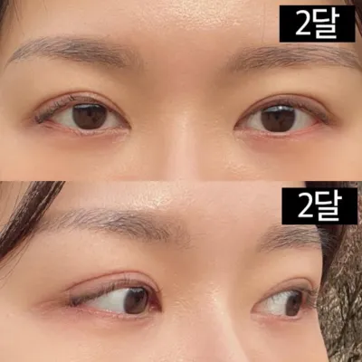 Би давхар зовхины дахин мэс засал болон нүдний хэлбэр засалтыг хийлгэсэн.