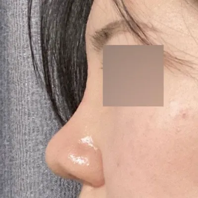 Мэс засал хийлгэсний дараах 1 сарын тойм. Би Wevers гоо сайхны мэс заслын эмнэлгийн дарга Шим Жун Хван эмчид хамар заслын мэс засал хийлгэсэн!