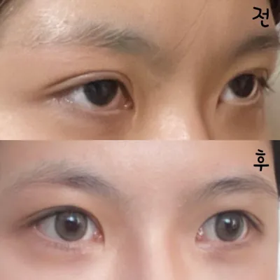 Ганнам дүүргийн Weavers гоо сайхны мэс заслын эмнэлэгт нүдний дахин мэс засал хийлгэснээс хойш хоёр сар болж байна!