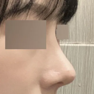 Хумсны мэс засал хийлгэснээс хойш 3 сар өнгөрчээ!