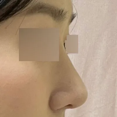 Шинэ хамар хийлгэсэндээ маш их сэтгэл хангалуун байна даа хаха