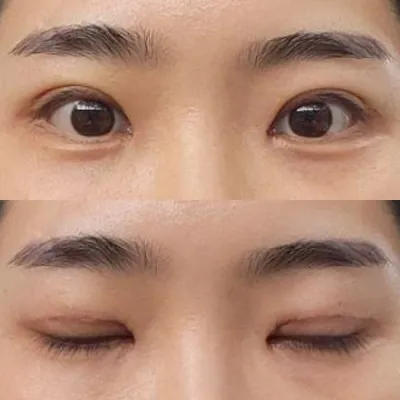 Нүдний дахин хагалгаа хийлгэснээс хойш долоо хоног боллоо