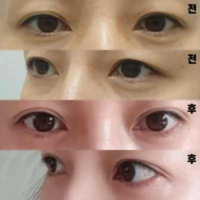 Мэс засал хийлгэсэндээ дахин баярлаж байна