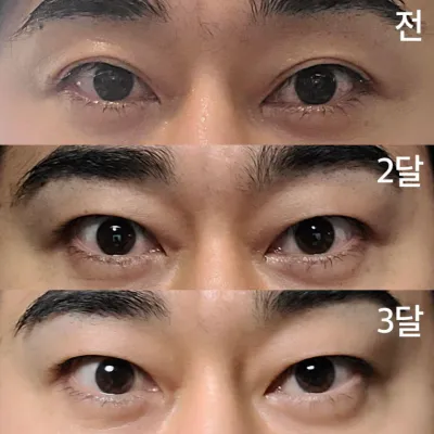 Давхар зовхины зүсэлт хийлгэснээс хойш 3 сар болж байна.