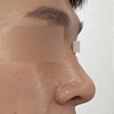 Би Вэбэрс гоо сайхны мэс заслын эмнэлэгт хамрагдаж, мэс засал хийлгэснээс хойш 2 сар болж байна.