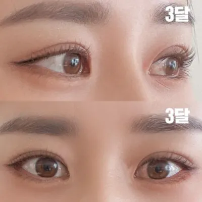 Намайг хүссэн хэв маягаар маш сайн мэс засал хийсэн шүү!!