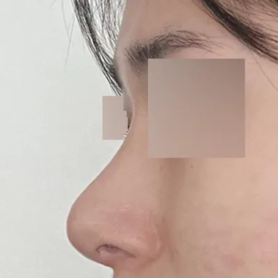 Виверс гоо сайхны мэс заслын эмнэлэгт хамар засварлуулснаас хойш хоёр сар болж байна.