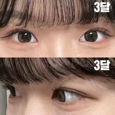 Би Сим Жон Хван эмчид ин-аутлайн хагалгаа хийлгэсэн.