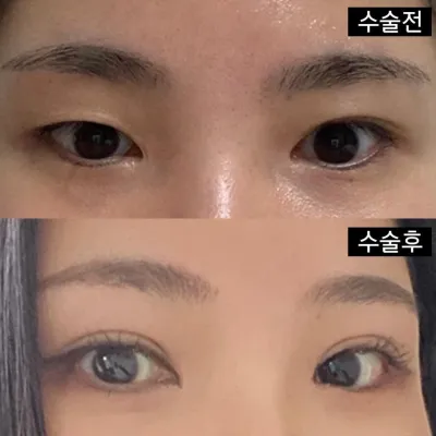 Хэрэв та давхар зовхины мэс засал, нүдний дахин мэс засал хийлгэх гэж байгаа бол заавал очиж үзэхийг зөвлөж байна