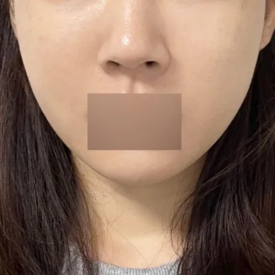 Виверс гоо сайхны мэс заслын эмнэлэгт утасны лифтинг хийлгэсэн эхний өдөр