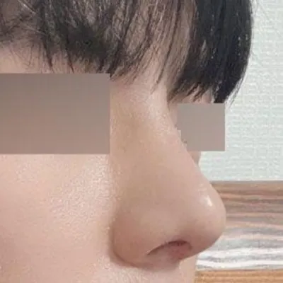 Хамар битүүрэх мэс засал болон өөрийгөө арчлах зорилгоор хагалгаанд орсон.