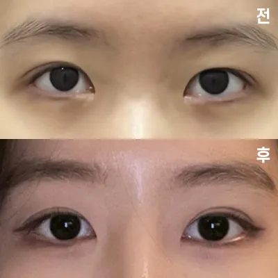 Виверс гоо сайхны мэс заслын эмнэлэгт хагалгаанд ороод 1 сар боллоо~! 