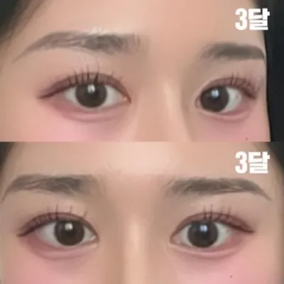 Би давхар зовхины хагалгаанд ороод 3 сар болж байна.