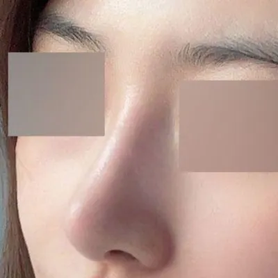 Хамрын дахин мэс засал хийлгэсний дараа ямар нэгэн асуудалгүй 3 сар өнгөрлөө ㅎㅎ