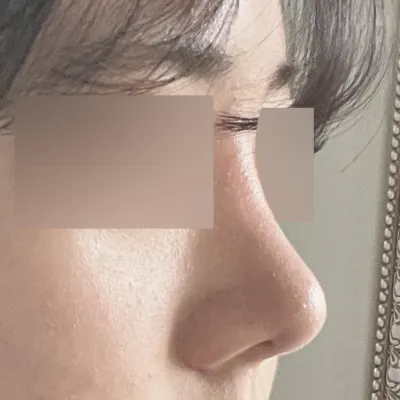 Хамрын дахин мэс засалд Webers хамгийн сайн