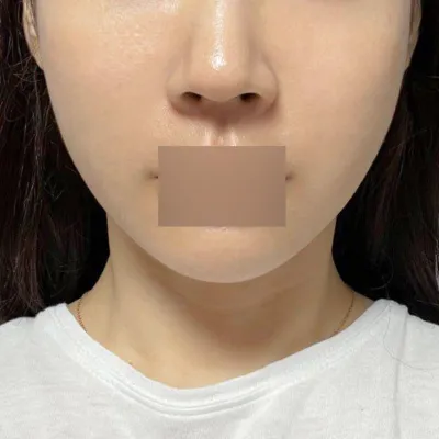 Утасны лифтинг хийлгэснээс хойш 2 долоо хоног болж байгаа ч үр дүн нь үнэхээр мэдэгдэж байна!