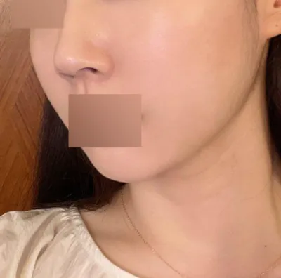 Нүүрний хэлбэр сайжирсан, хэдэн жилээр залуу харагдаж байна. Маш гоё байна.