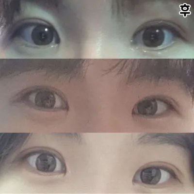 Нүд унжсанаас болж өөртөө итгэлгүй байсан ч хагалгааны дараа өөртөө итгэлтэй болсон шүү ㅠㅠㅠㅠ