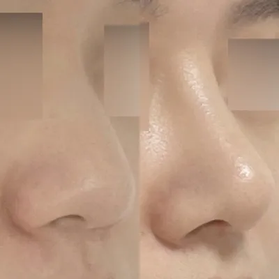 Би хамар томруулах мэс заслыг имплантгүйгээр хийлгэсэн