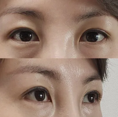 Бодохоор үнэхээр догдолж байна! Мэс засал хийлгэсэндээ маш их баяртай байна