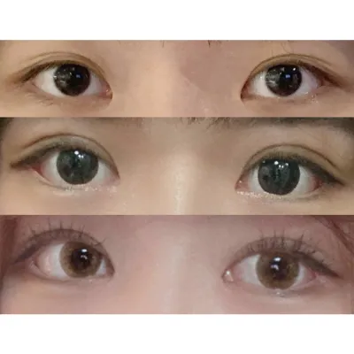 Ар шилэн мэс засал + байгалийн наалдац + нүдний хэлбэр засах мэс заслын дараах сэтгэгдэл!