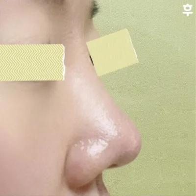 Хамрын мэс засал бол миний амьдралд хийсэн хамгийн зөв сонголт гэж бодож байна!