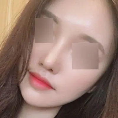 Би Виверсэд хамрын хагалгаанд ороод 3 сар боллоо!