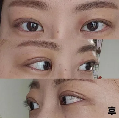 Мэс засал хийлгэсэн нь үнэхээр зөв шийдвэр байсан